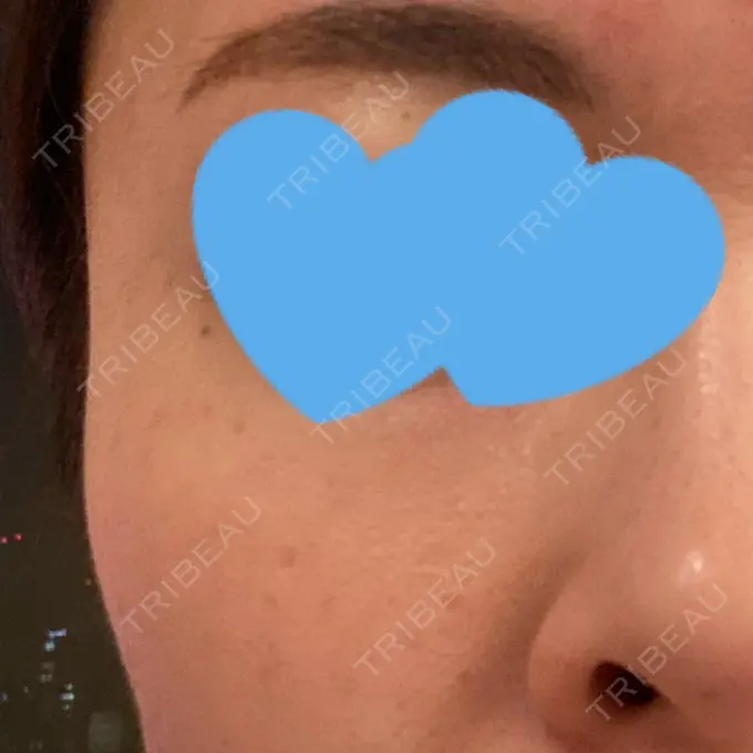 イオン導入 / 毛穴洗浄（ハイドラフェイシャルなど） / ルメッカ ルラ美容クリニック 渋谷本院 DAY 6 メイン用