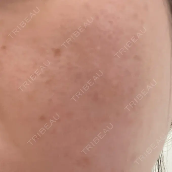 サブシジョン / 肌育注射（ジュベルックなど） / その他（肌） ゆきスキンクリニック 東池袋 AFTER メイン用