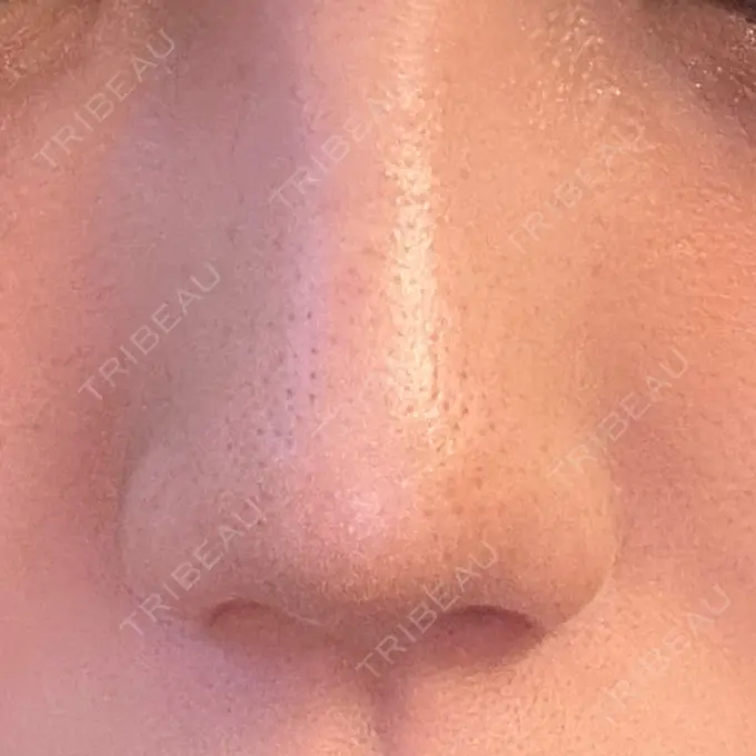 小鼻縮小（切開） / 鼻翼挙上 / その他（鼻） 東京形成美容外科 銀座院 AFTER メイン用