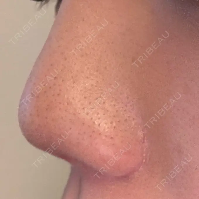 小鼻縮小（切開） / 鼻翼挙上 / その他（鼻） 東京形成美容外科 銀座院 DAY 75 メイン用