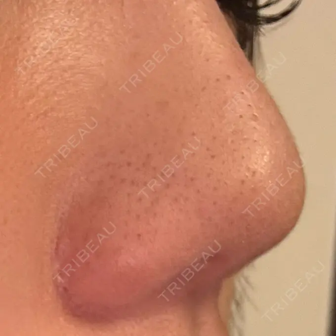 小鼻縮小（切開） / 鼻翼挙上 / その他（鼻） 東京形成美容外科 銀座院 DAY 75 メイン用