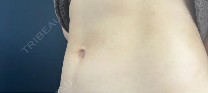 へそ形成 藤・ナチュレ美容クリニック 銀座院 DAY 0 メイン用