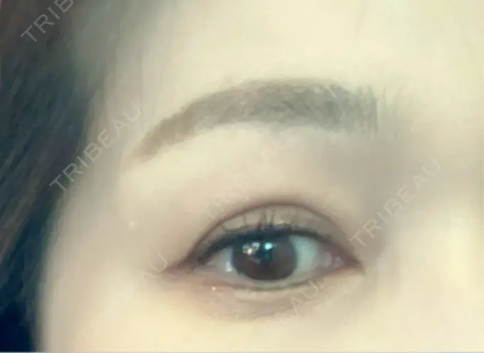 二重埋没 / 目元修正 オーキッド美容クリニック東京御徒町 DAY 641 メイン用