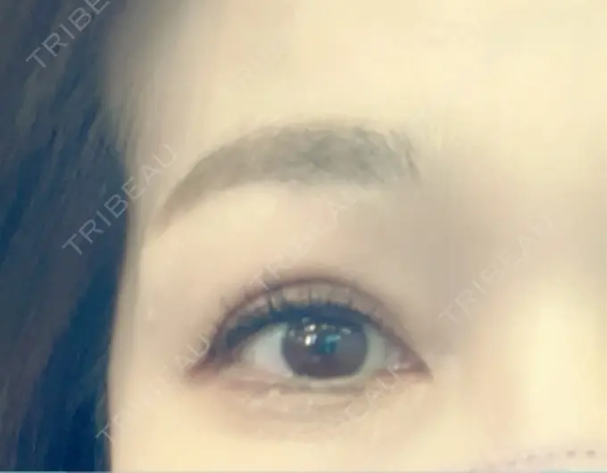 二重埋没 / 目元修正 オーキッド美容クリニック東京御徒町 AFTER メイン用