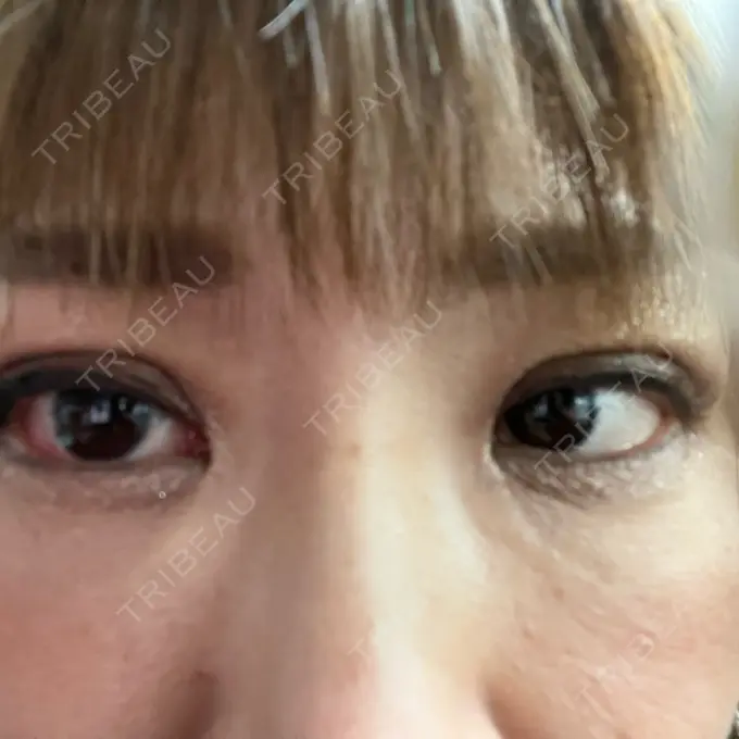 二重埋没 ネビュラクリニック 広島院 DAY 4 メイン用