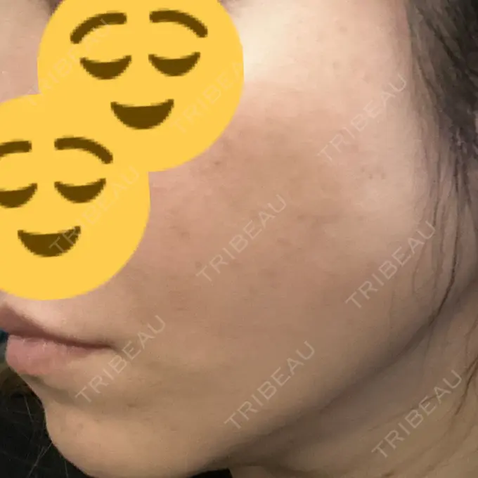 糸リフト DMTC CLINIC 日本橋院 DAY 20 メイン用