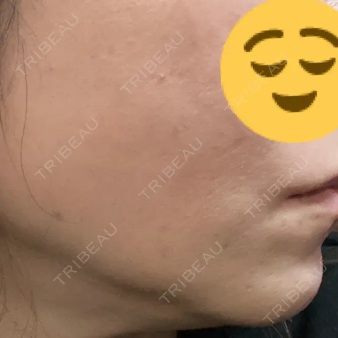 糸リフト DMTC CLINIC 日本橋院 DAY 20 メイン用