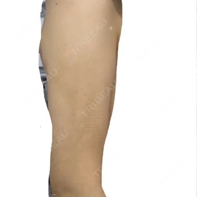 脂肪吸引（二の腕） / 脂肪吸引（肩） BBC銀座院 DAY 14 メイン用