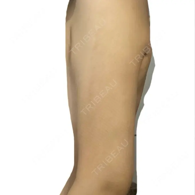 脂肪吸引（二の腕） / 脂肪吸引（肩） BBC銀座院 DAY 14 メイン用