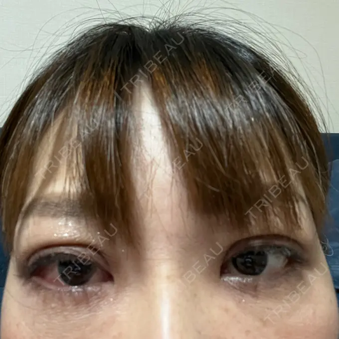 二重埋没 ネビュラクリニック 広島院 DAY 5 メイン用