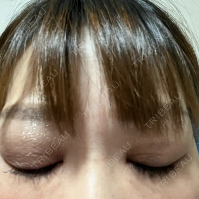 二重埋没 ネビュラクリニック 広島院 DAY 5 メイン用