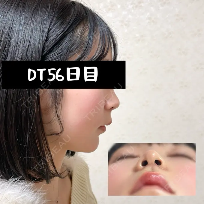 小鼻縮小（切開） / 人中短縮 / 鼻翼挙上 / 鼻翼基部形成（貴族手術） / 鼻柱下降・鼻唇角形成（猫手術） Otus Clinic 【オータスクリニック】 DAY 56 メイン用