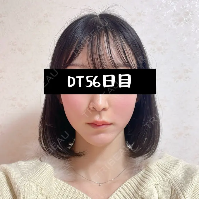 小鼻縮小（切開） / 人中短縮 / 鼻翼挙上 / 鼻翼基部形成（貴族手術） / 鼻柱下降・鼻唇角形成（猫手術） Otus Clinic 【オータスクリニック】 DAY 56 メイン用