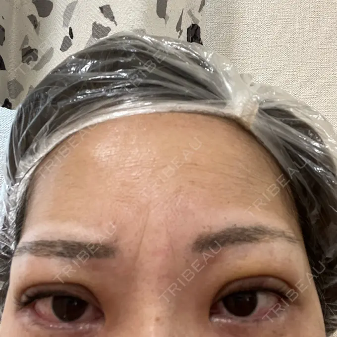 二重埋没 ネビュラクリニック 広島院 DAY 6 メイン用