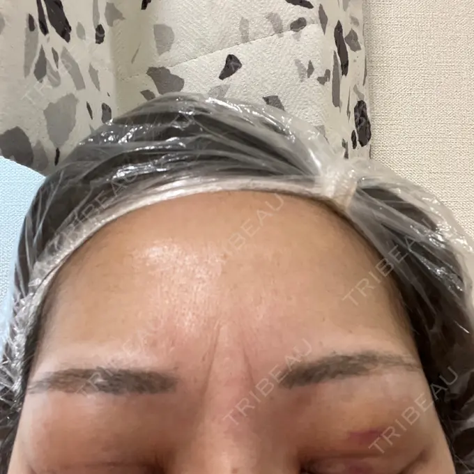 二重埋没 ネビュラクリニック 広島院 DAY 6 メイン用