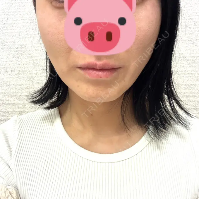 糸リフト Mods Clinic（モッズクリニック） 名古屋院 DAY 6 メイン用