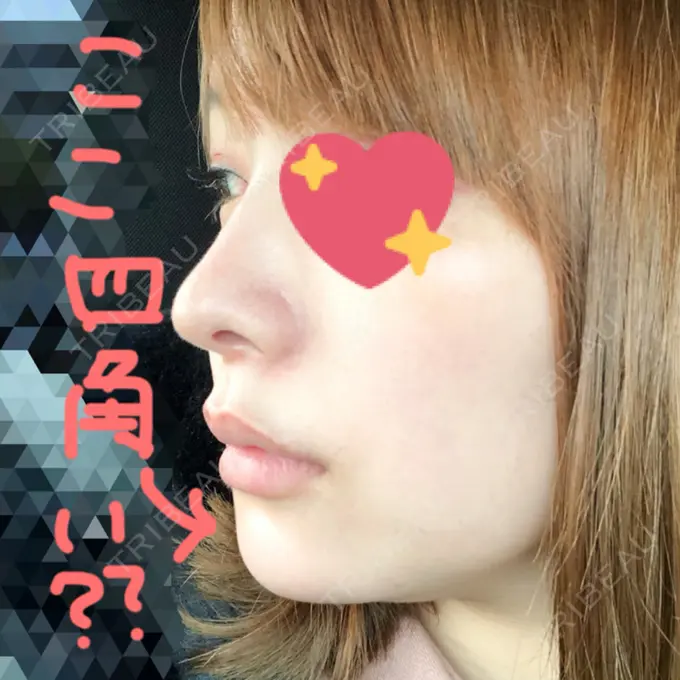 あごプロテーゼ / 輪郭修正 高崎TAクリニック DAY 8 メイン用