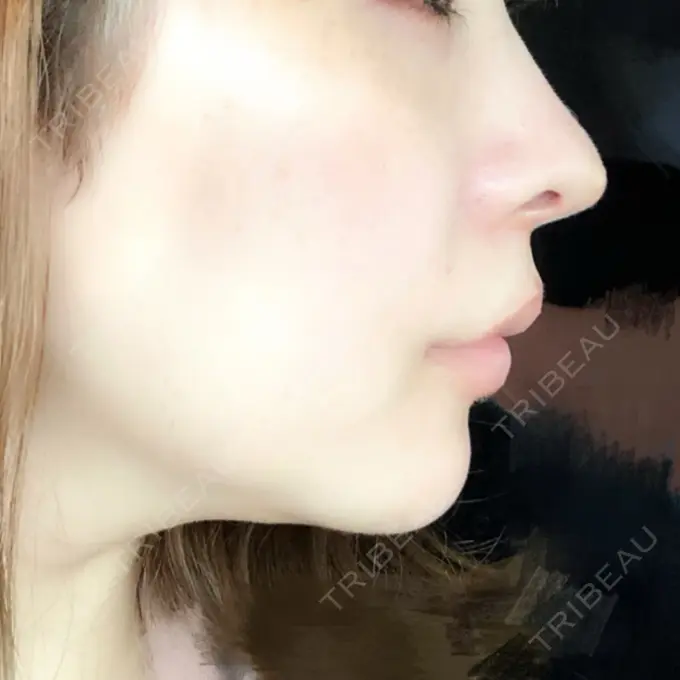 あごプロテーゼ / 輪郭修正 高崎TAクリニック DAY 8 メイン用