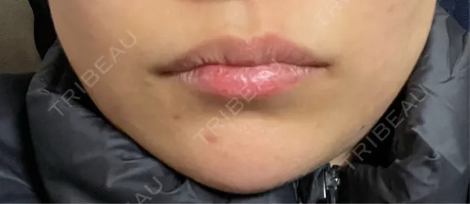 ボトックス（エラ・小顔） L‘amour clinic Tokyo【ラムールクリニック東京】 AFTER メイン用