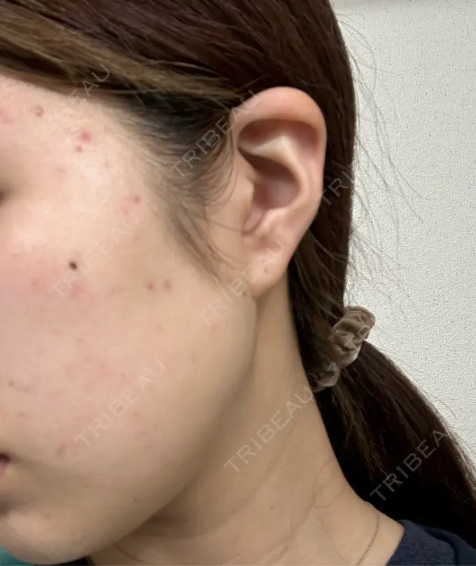 ピーリング（ニキビ・毛穴） おおたかの森ビューティークリニック DAY 0 メイン用