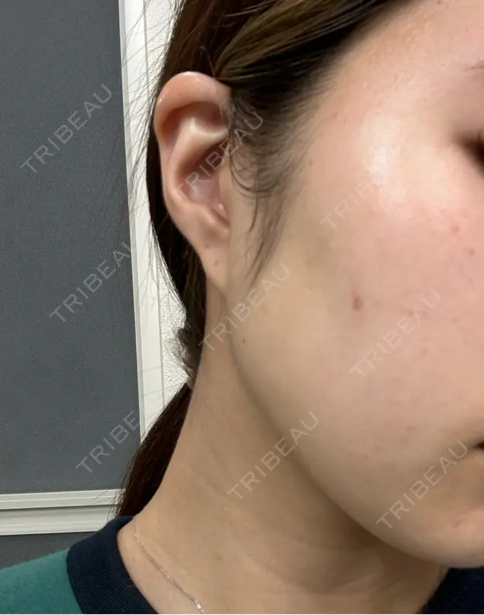 ピーリング（ニキビ・毛穴） おおたかの森ビューティークリニック DAY 0 メイン用