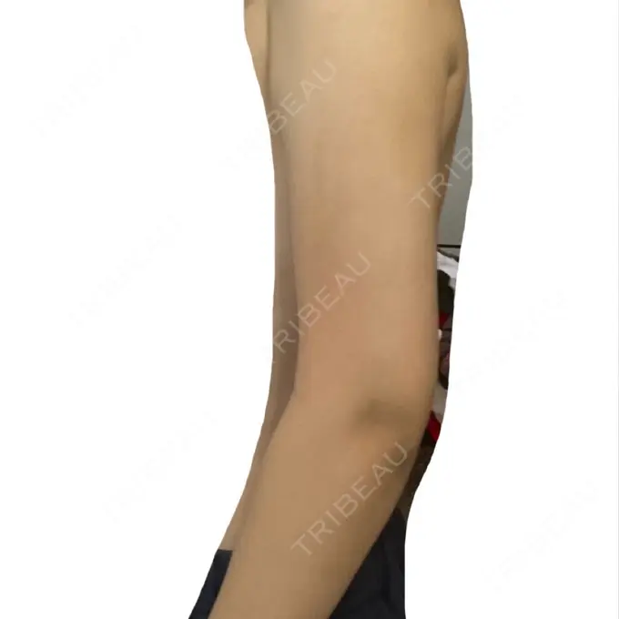 脂肪吸引（二の腕） / 脂肪吸引（肩） BBC銀座院 AFTER メイン用