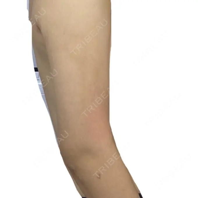 脂肪吸引（二の腕） / 脂肪吸引（肩） BBC銀座院 DAY 16 メイン用