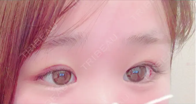 二重埋没 A CLINIC（エークリニック） 仙台院 AFTER メイン用