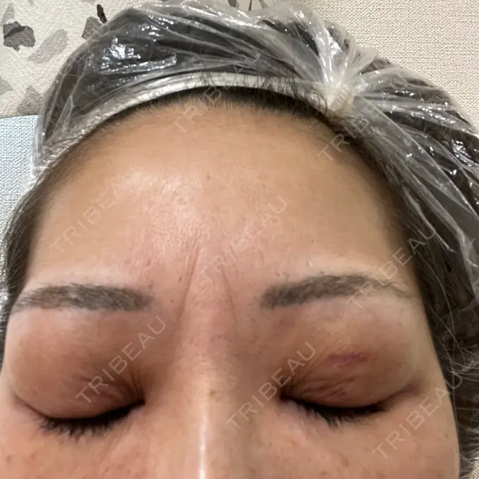 二重埋没 ネビュラクリニック 広島院 DAY 7 メイン用