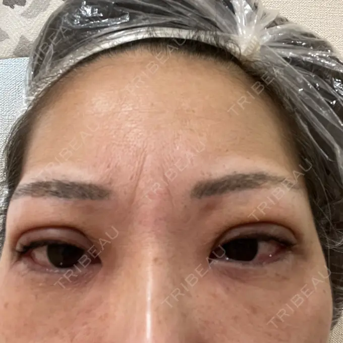 二重埋没 ネビュラクリニック 広島院 DAY 7 メイン用