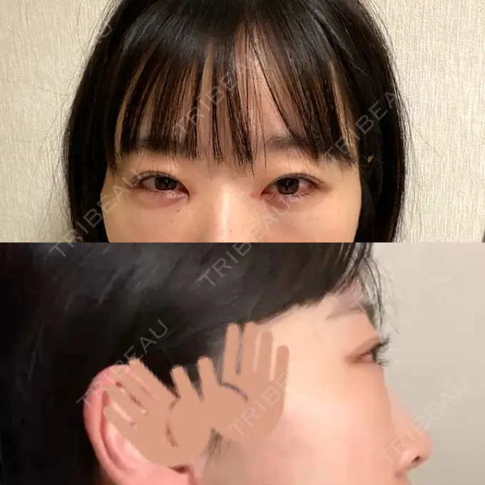 クマ治療 / ヒアルロン酸注入（目の下） / スネコス Tokyo Tensei Clinic 新宿院 DAY 1 メイン用