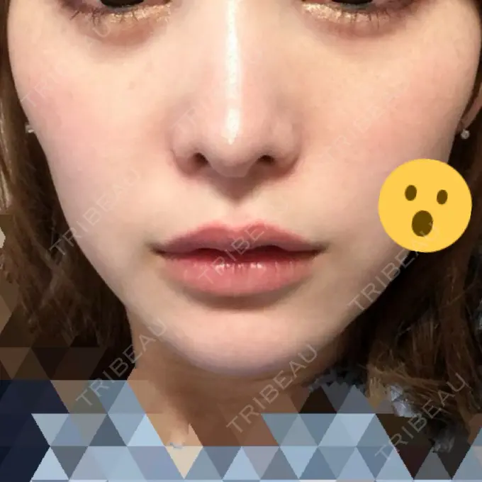 あごプロテーゼ / 輪郭修正 高崎TAクリニック DAY 10 メイン用