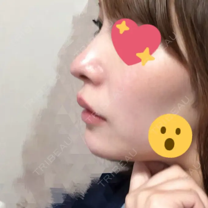 あごプロテーゼ / 輪郭修正 高崎TAクリニック DAY 10 メイン用