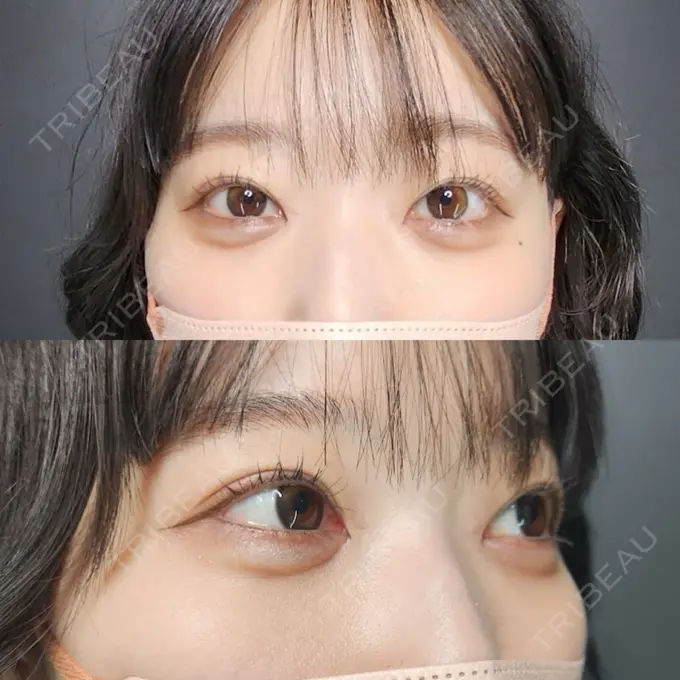 クマ治療 / ヒアルロン酸注入（目の下） / スネコス Tokyo Tensei Clinic 新宿院 AFTER メイン用