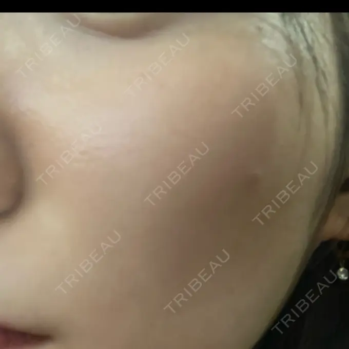 ボトックス（眉間） / ボトックス（目尻） TCB東京中央美容外科 新宿三丁目院 AFTER メイン用