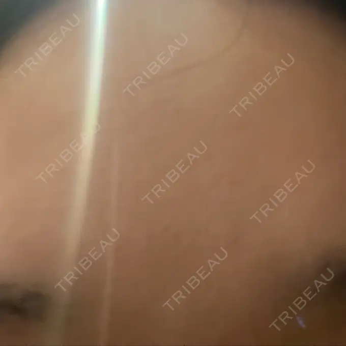 ボトックス（眉間） / ボトックス（目尻） TCB東京中央美容外科 新宿三丁目院 DAY 0 メイン用