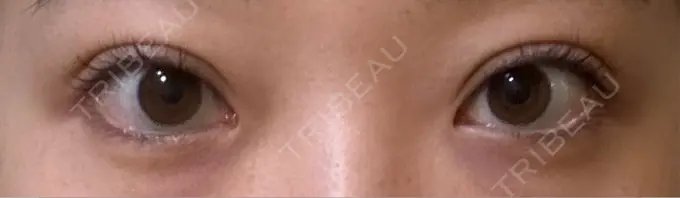 二重埋没 / 上まぶたたるみ取り 湘南美容クリニック 池袋東口院 DAY 12 メイン用