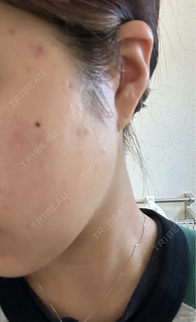 ピーリング（ニキビ・毛穴） おおたかの森ビューティークリニック DAY 1 メイン用