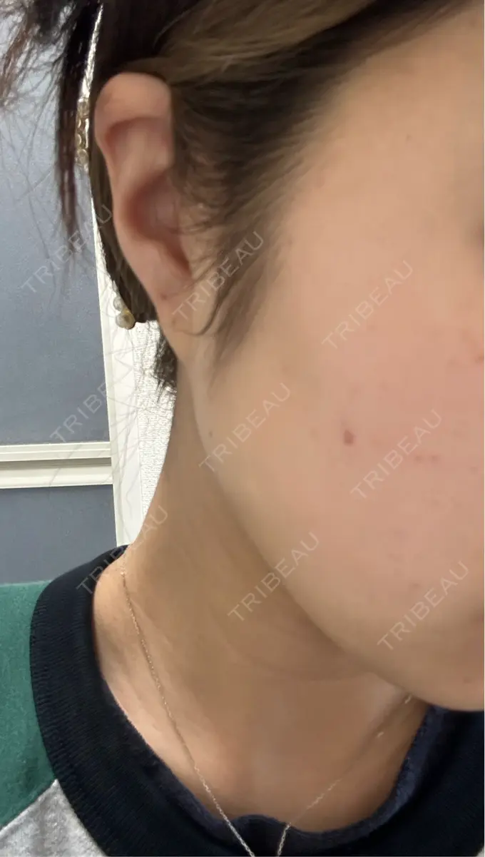 ピーリング（ニキビ・毛穴） おおたかの森ビューティークリニック DAY 1 メイン用