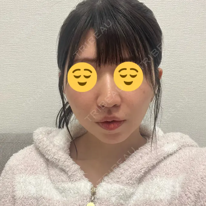 小鼻縮小（切開） / 人中短縮 / 鼻翼挙上 / ボトックス（ガミースマイル） Otus Clinic 【オータスクリニック】 AFTER メイン用