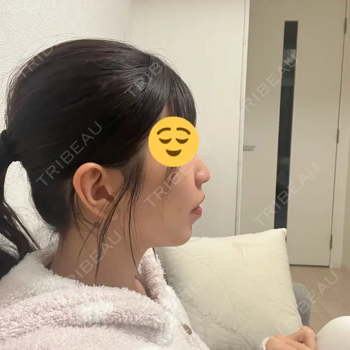 小鼻縮小（切開） / 人中短縮 / 鼻翼挙上 / ボトックス（ガミースマイル） Otus Clinic 【オータスクリニック】 DAY 60 メイン用