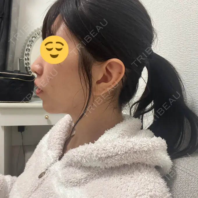 小鼻縮小（切開） / 人中短縮 / 鼻翼挙上 / ボトックス（ガミースマイル） Otus Clinic 【オータスクリニック】 DAY 60 メイン用