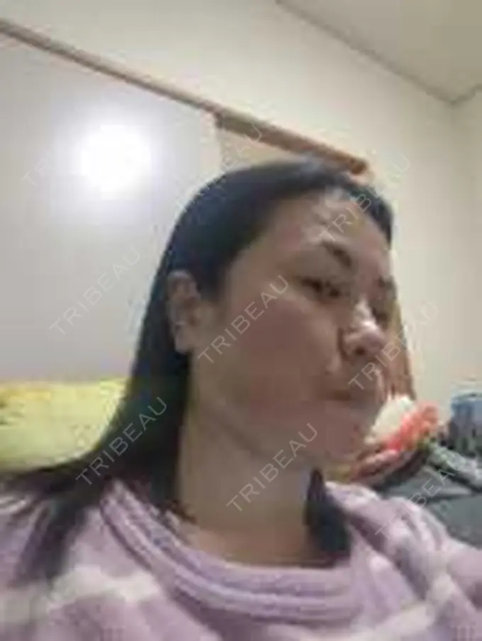 ボトックス（エラ・小顔） / 高濃度ビタミンC点滴 TCB東京中央美容外科 松山院 DAY 24 メイン用