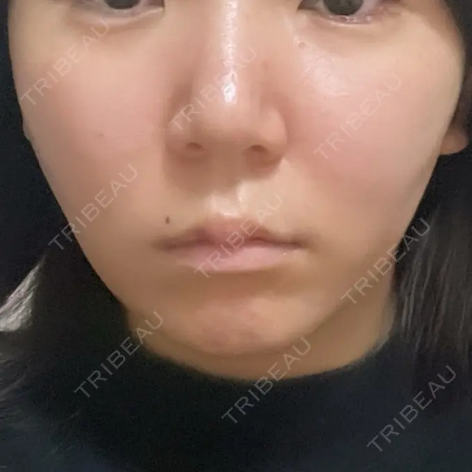 二重埋没 / 糸リフト / ヒアルロン酸注入（涙袋） / ボトックス（エラ・小顔） / ヒアルロン酸注入（頬） 東京シンデレラ美容外科 池袋院 DAY 0 メイン用