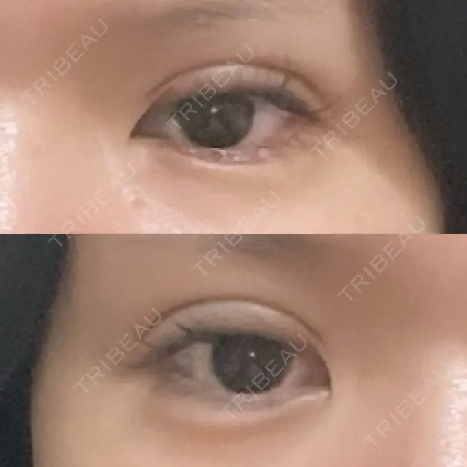 二重埋没 / 糸リフト / ヒアルロン酸注入（涙袋） / ボトックス（エラ・小顔） / ヒアルロン酸注入（頬） 東京シンデレラ美容外科 池袋院 DAY 0 メイン用