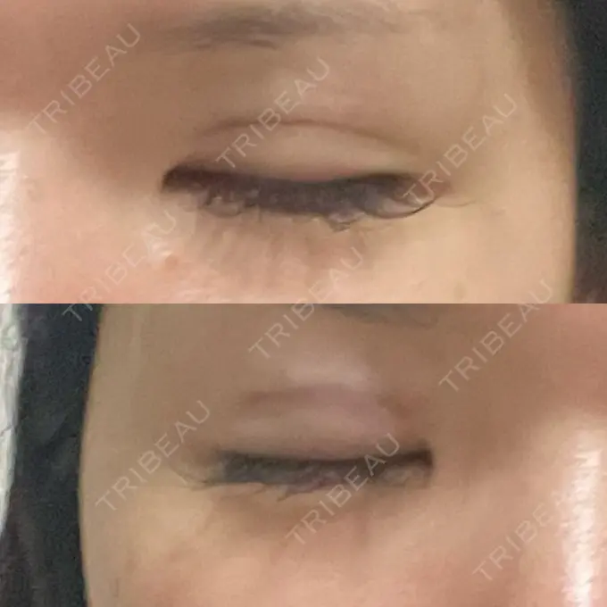 二重埋没 / 糸リフト / ヒアルロン酸注入（涙袋） / ボトックス（エラ・小顔） / ヒアルロン酸注入（頬） 東京シンデレラ美容外科 池袋院 DAY 0 メイン用