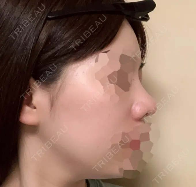 隆鼻術 / 鼻尖形成（切開） / 小鼻縮小（切開） 湘南美容クリニック 岡山院 DAY 124 メイン用