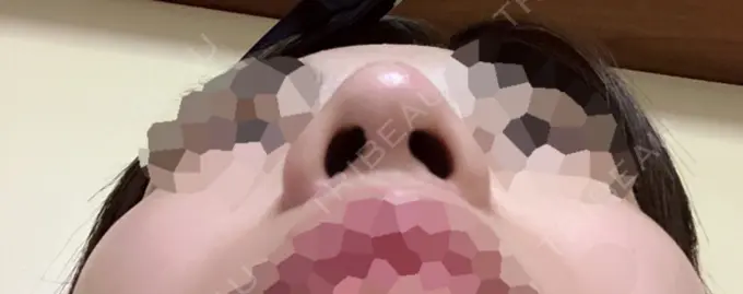 隆鼻術 / 鼻尖形成（切開） / 小鼻縮小（切開） 湘南美容クリニック 岡山院 DAY 124 メイン用