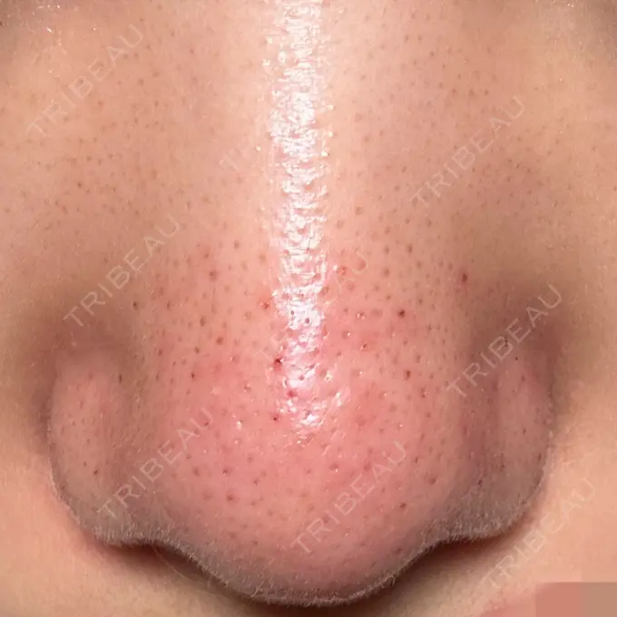 アグネス 日本美容・医療クリニック 六本木院 AFTER メイン用