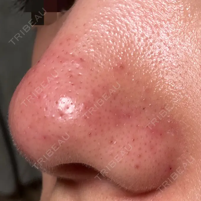 アグネス 日本美容・医療クリニック 六本木院 DAY 3 メイン用